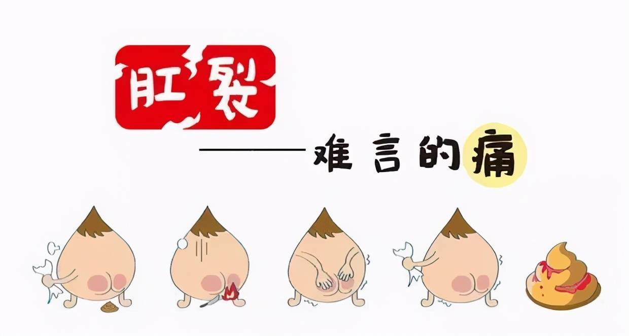 3期 三联肛裂:裂口呈陈旧性溃疡,合并肛乳头肥大及哨痔.