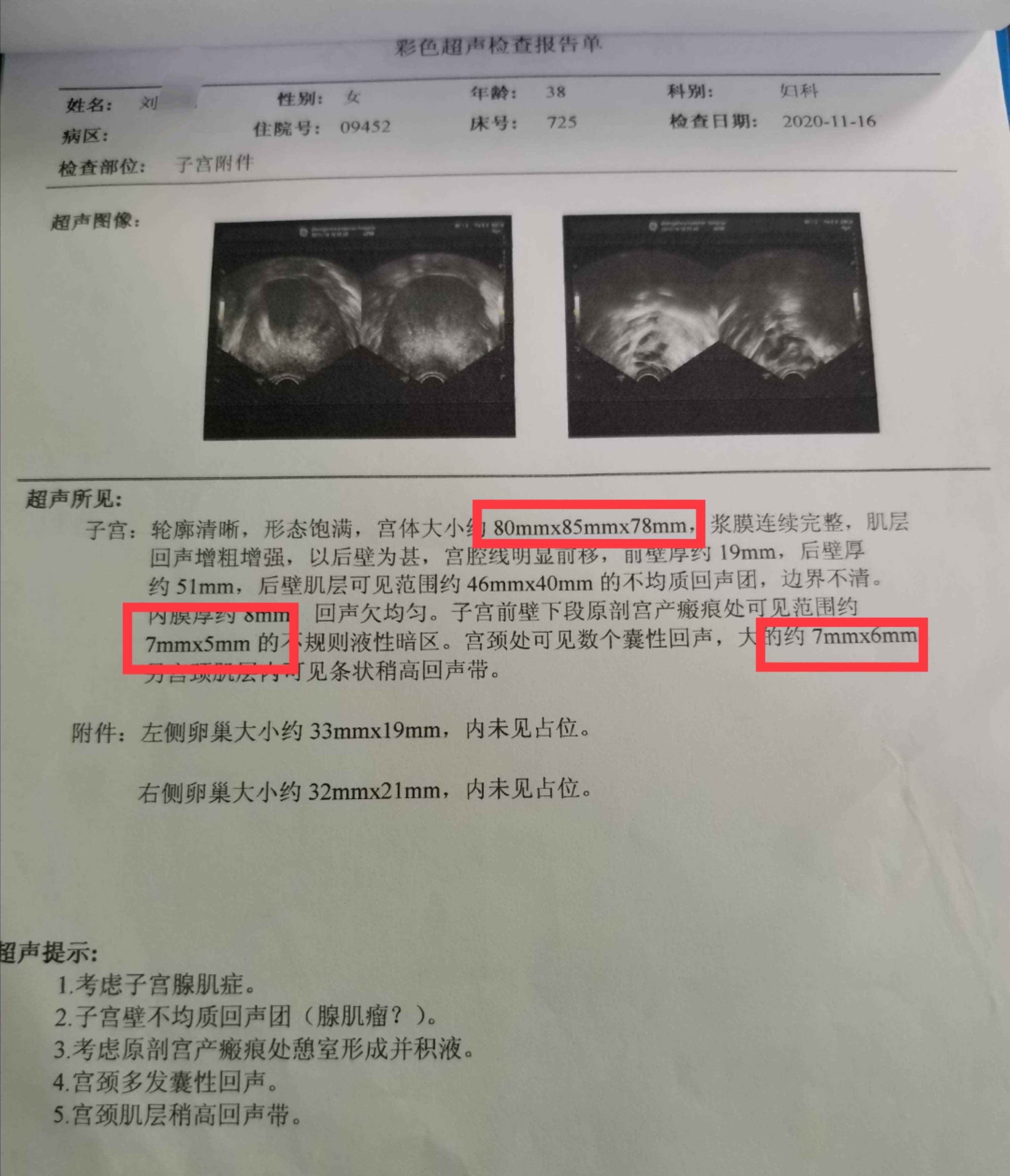 子宫腺肌症12年了