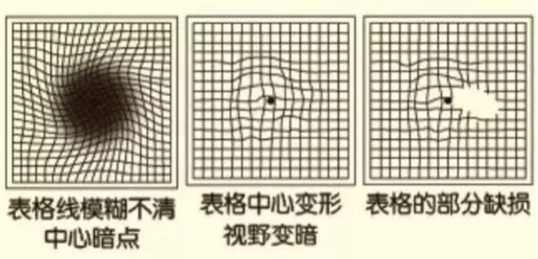 看东西变形扭曲是眼睛在报警