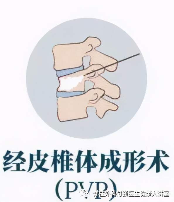 经皮后凸成形术是利用经皮球囊扩张椎体,在椎体内形成一个空间,可以