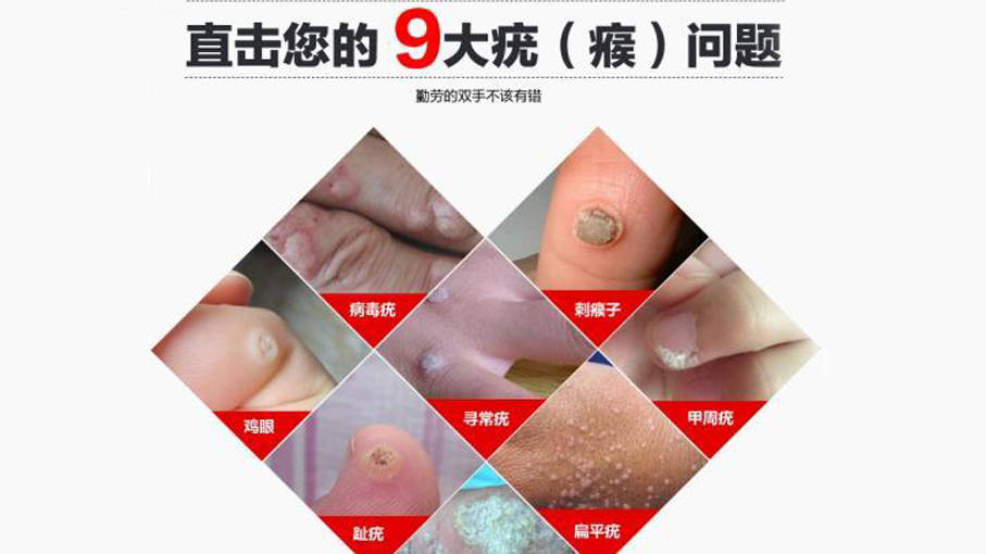 诊治扁平疣期间需注意什么事项_饮食