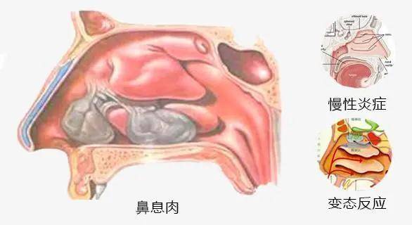 别被鼻息肉迷惑了!