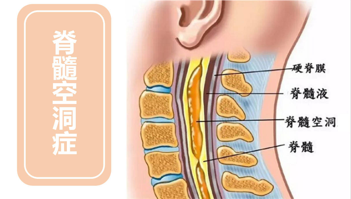 北京脊髓空洞德胜门脊髓空洞症以及临床症状都有哪些呢
