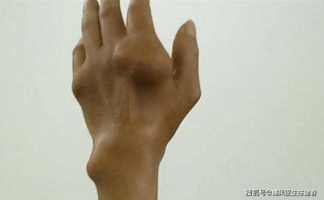 类风湿结节还是痛风结节到底要怎么区分