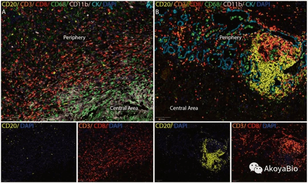 journal of cancer》鳞状上皮癌研究panel 1 cd68,cd33,cd14,cd163