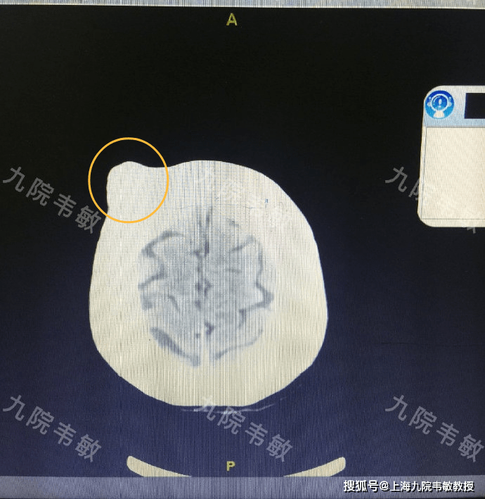 九院韋敏日常丨罕見較大顱骨骨瘤,需手術切除治療_手機搜狐網