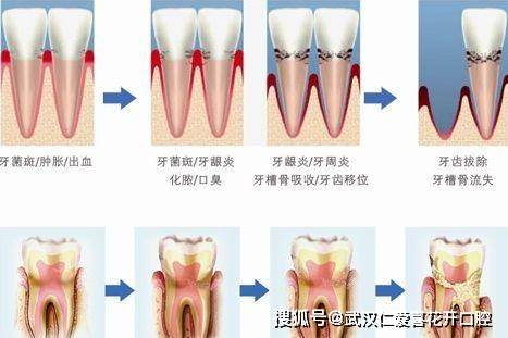 有了這些症狀要小心牙周炎了小心引發牙疼直接導致牙齒鬆動