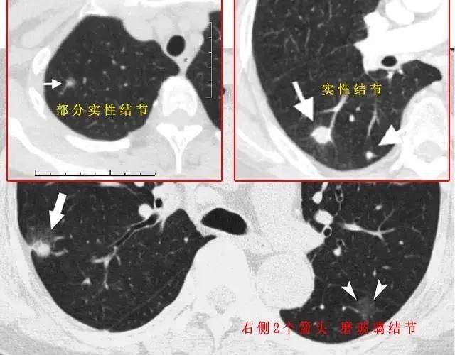 中医可以消除肺结节吗