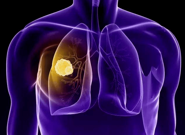 18岁女孩手痒查出肺癌,医生:身体"3处"发痒,肺或许已受损