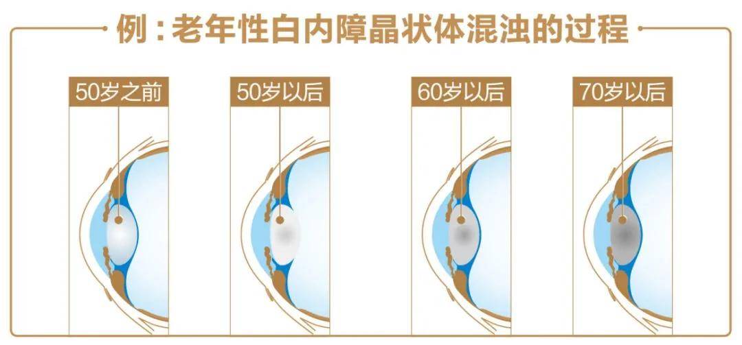 老年性|你知道吗？这几类人需定期给眼睛“体检”