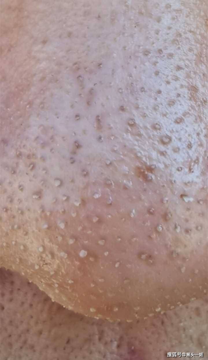 别再错误的去黑头了!