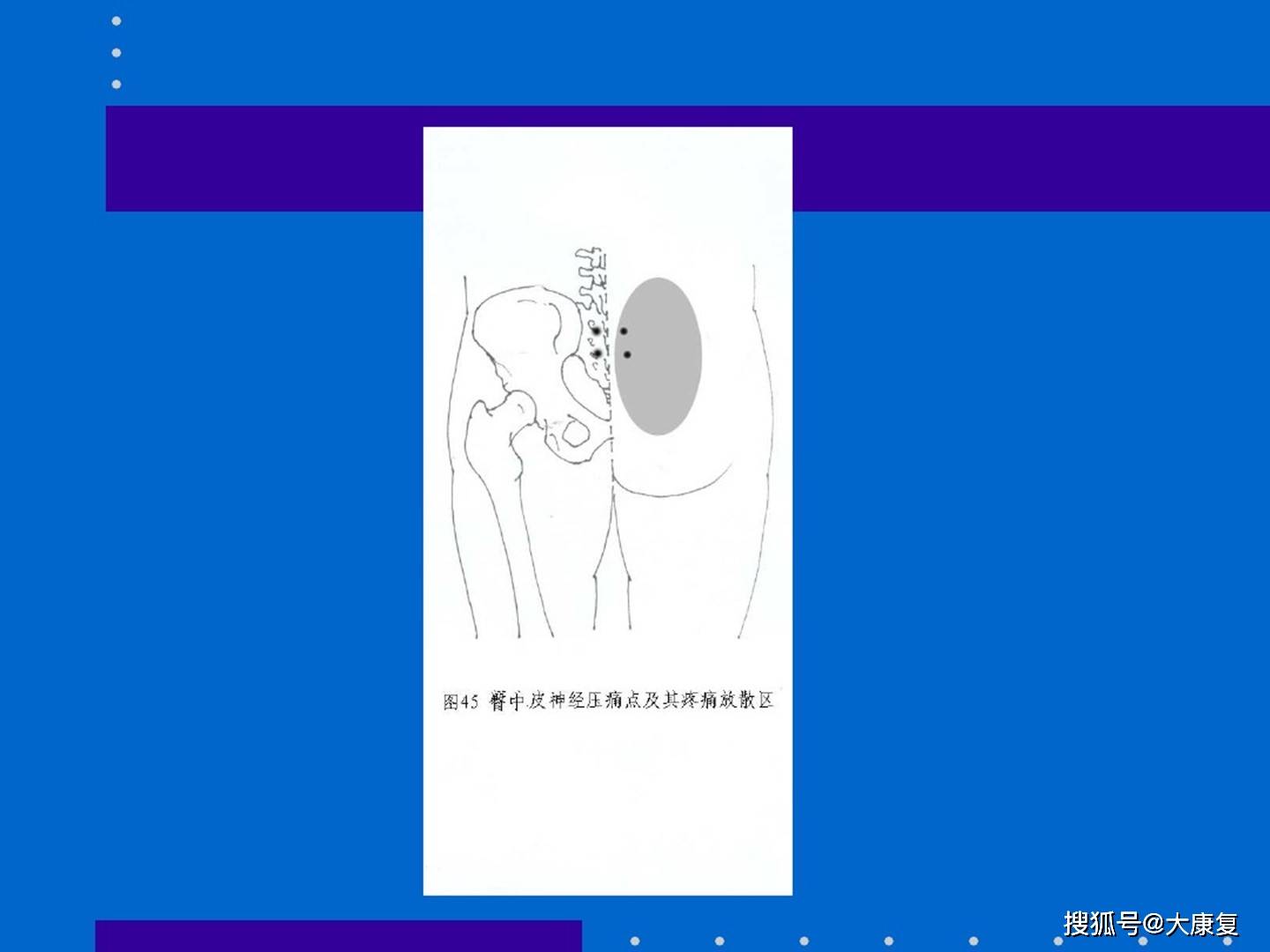 皮神经卡压综合征
