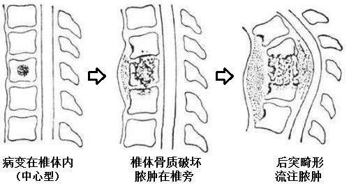 生命支柱遭遇結核桿菌老漢腰椎被掏空險癱瘓