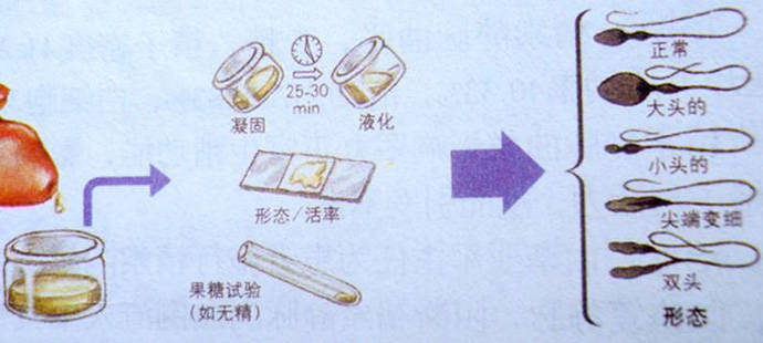 精液像果冻 有颗粒晶块是怎么回事 精液不液化可致男性不育 精子