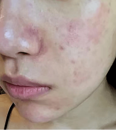 慎用孕期别再乱用纯天然护肤品了别等烂脸才后悔