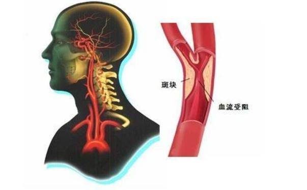 颈动脉有了斑块 对哪里影响最大 有了斑块后要注意什么 来看看 血管
