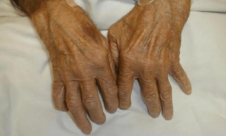 手风湿病的症状是什么？