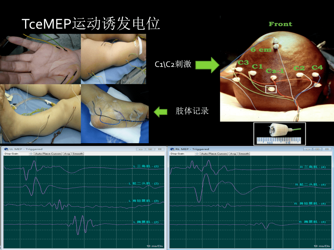 术中神经电生理监测的临床应用