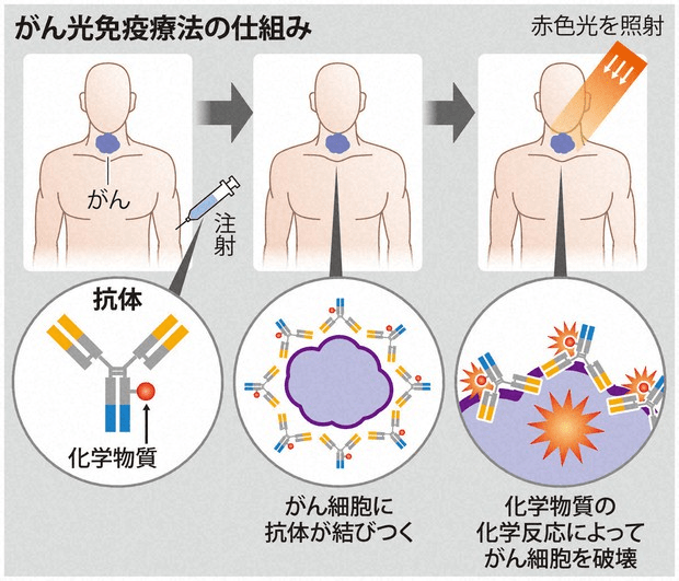 先进的光免疫疗法进日本医保治疗费用仅数十万日元 癌细胞