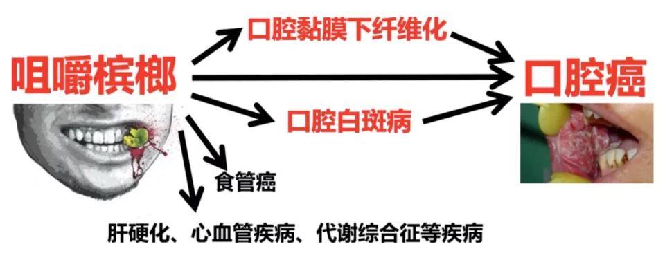 損害口腔誘發口腔癌檳榔纖維粗糙,長期嚼檳榔,極易損傷口腔粘膜,傷口