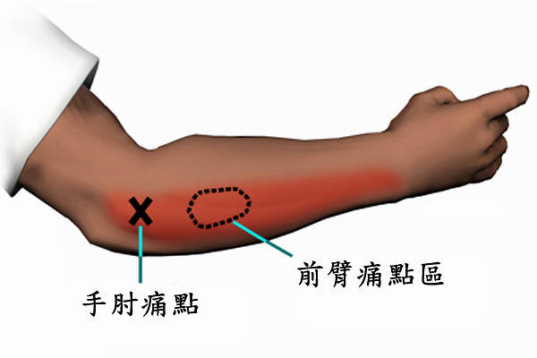 網球肘一般多久能好幾個方式教你快速康復