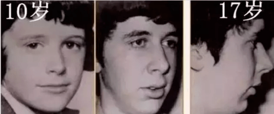 长期张嘴呼吸真的会改变原本的容貌,出现上下颌,地包天的"腺样体面容"