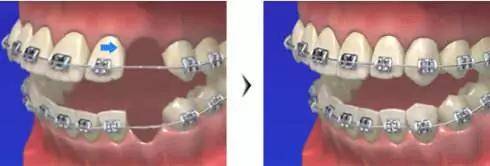 拔牙矫正