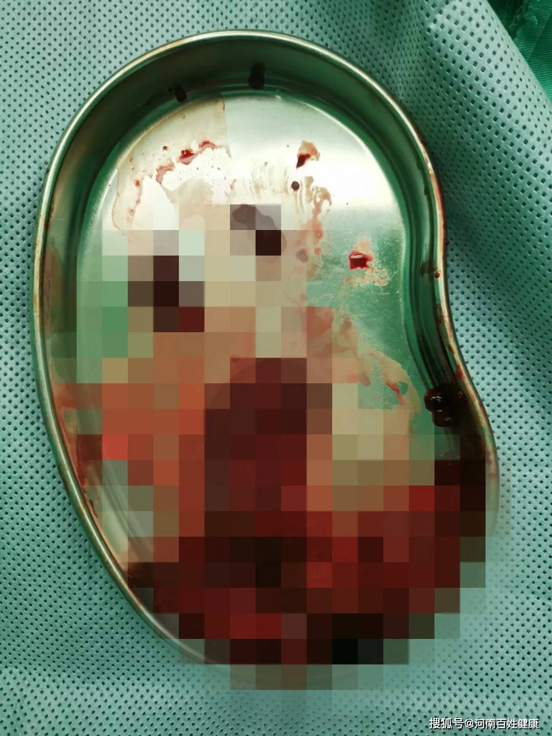 科,手术室的密切配合下,历经三个小时,终于完成了这台脾脏切除手术