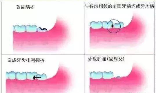 智齿总是发炎 什么时候拔才好 牙齿