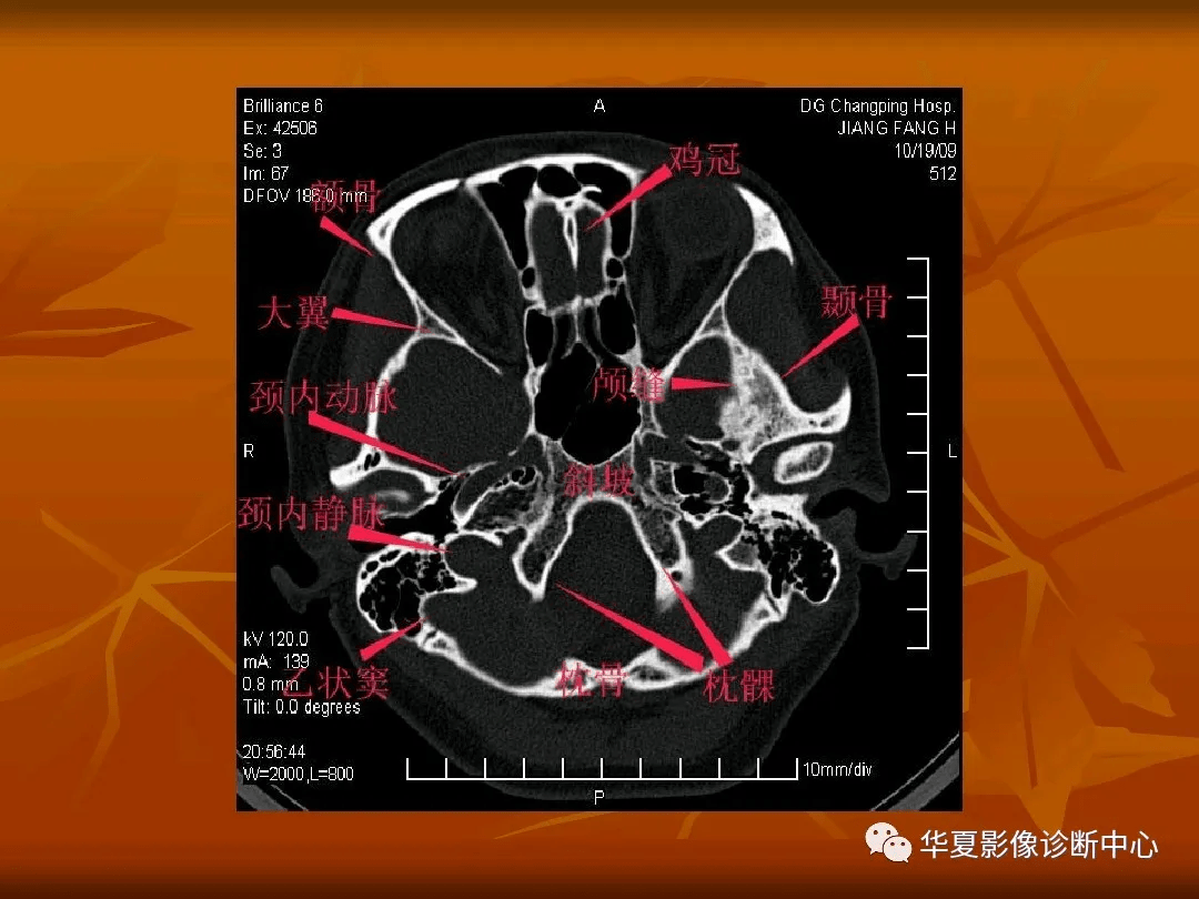 顱底ct高清圖解 常見骨折部位圖示