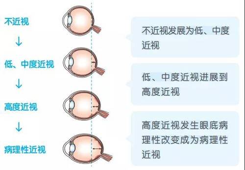 眼睛中度近视怎么办