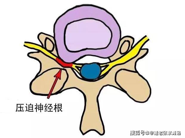 非遗老张家膏贴:小心这些症状! 神经根型颈椎病