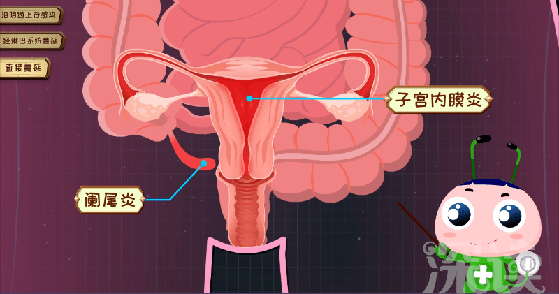 子宫内膜炎3:四招教你远离妇科炎症