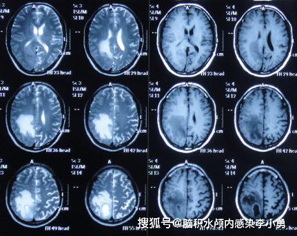 圖-2:2020年2月1日頭顱影像圖-1:2020年2月1日頭顱血管cta患者於2020