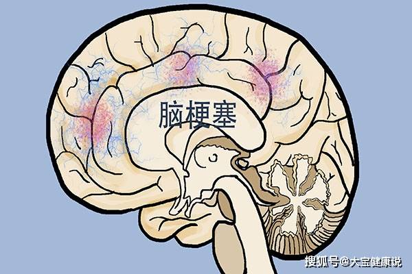什么办法可以缓解手麻 c8217f947d944889a7183ac1fe080bf0.jpeg