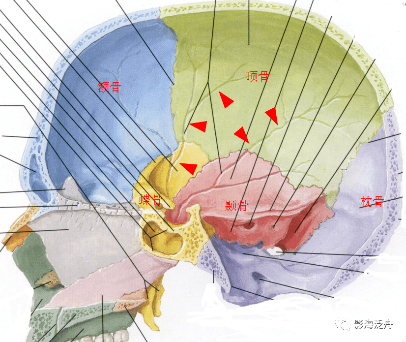 蝶鱗縫,枕乳縫,蝶額縫也是與骨折鑑別的重點對象.
