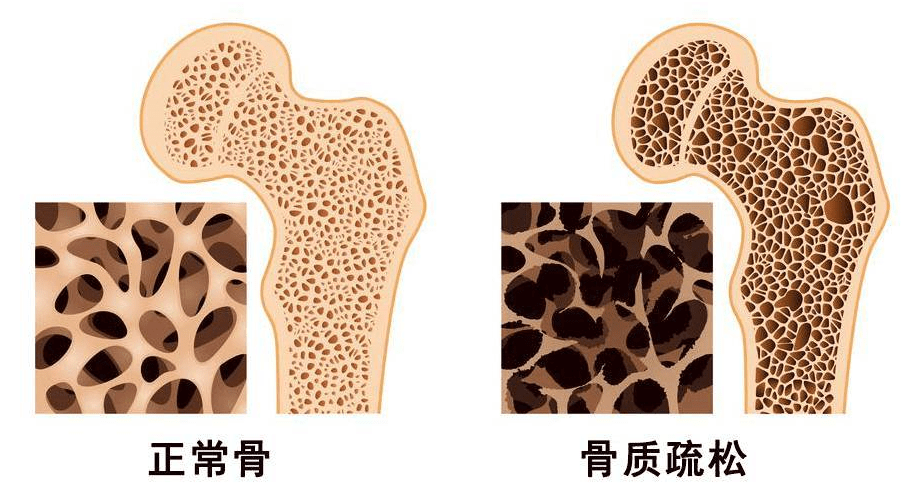 什么是骨密度稀疏 176ee38487f842be8716dcf47b23cd83.png