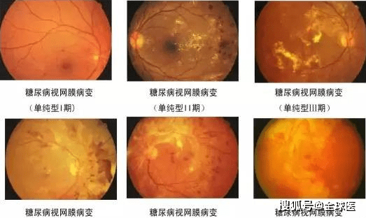 爱眼底 糖尿病患者有此症状 可能是视网膜病变 要怎么预防 检查