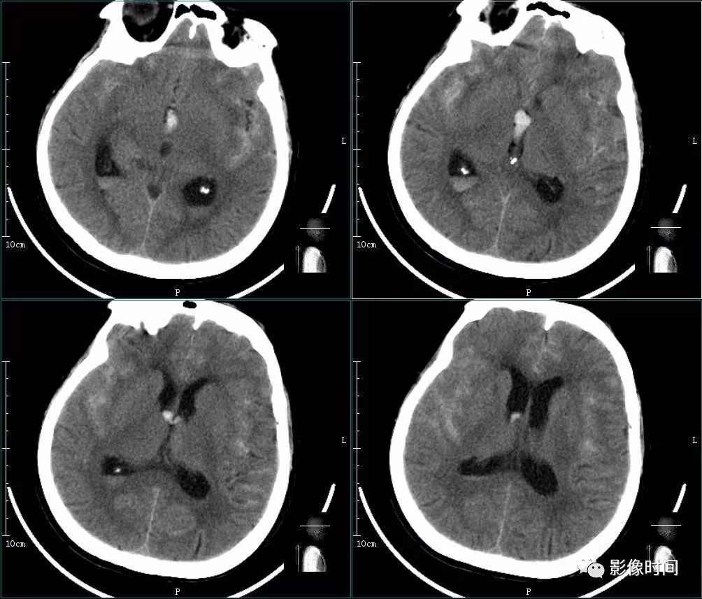 平掃示蛛網膜下腔出血,腦室出血; cta:vr,mip