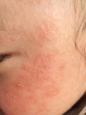 婴儿湿疹到底怎么处理?收下这份详细版攻略