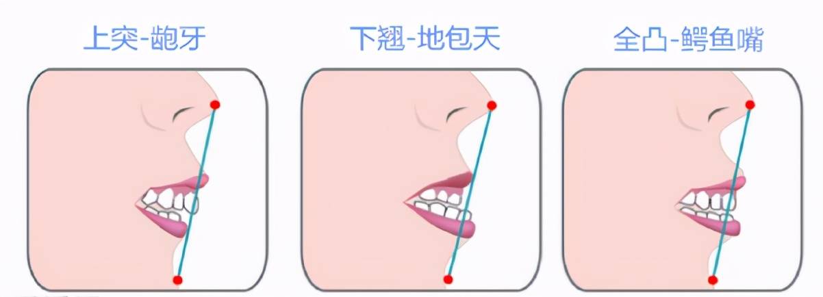 口腔|别诓我，3D打印竟然能矫正牙齿？