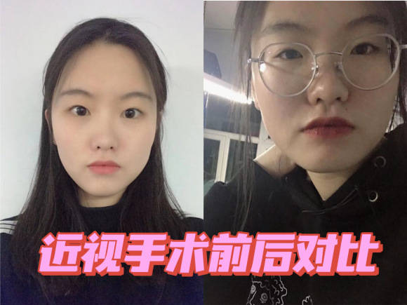 少女摘镜变化大分享个人烟台近视眼手术感想