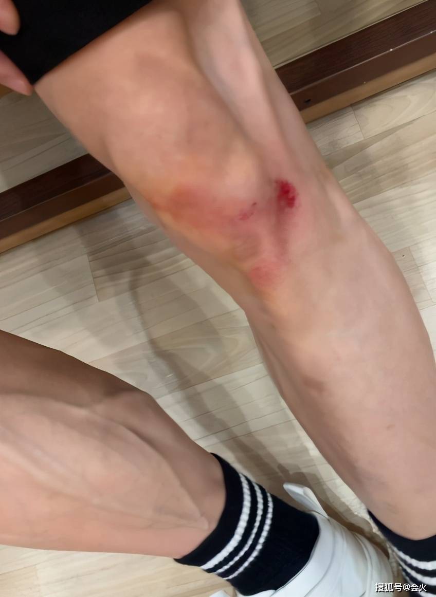 30岁张一山片场打球摔伤膝盖 大片红肿淤青血迹 与关晓彤一般高 受伤