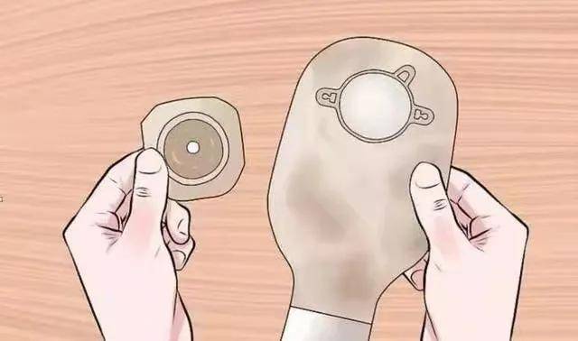 居家造口护理的那些事儿