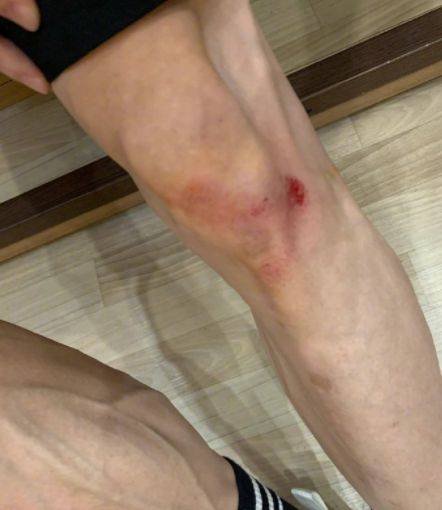 原创张一山运动时膝盖摔伤还问候了一下自己张一山也太调皮了