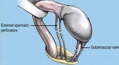 精索静脉曲张部位图片