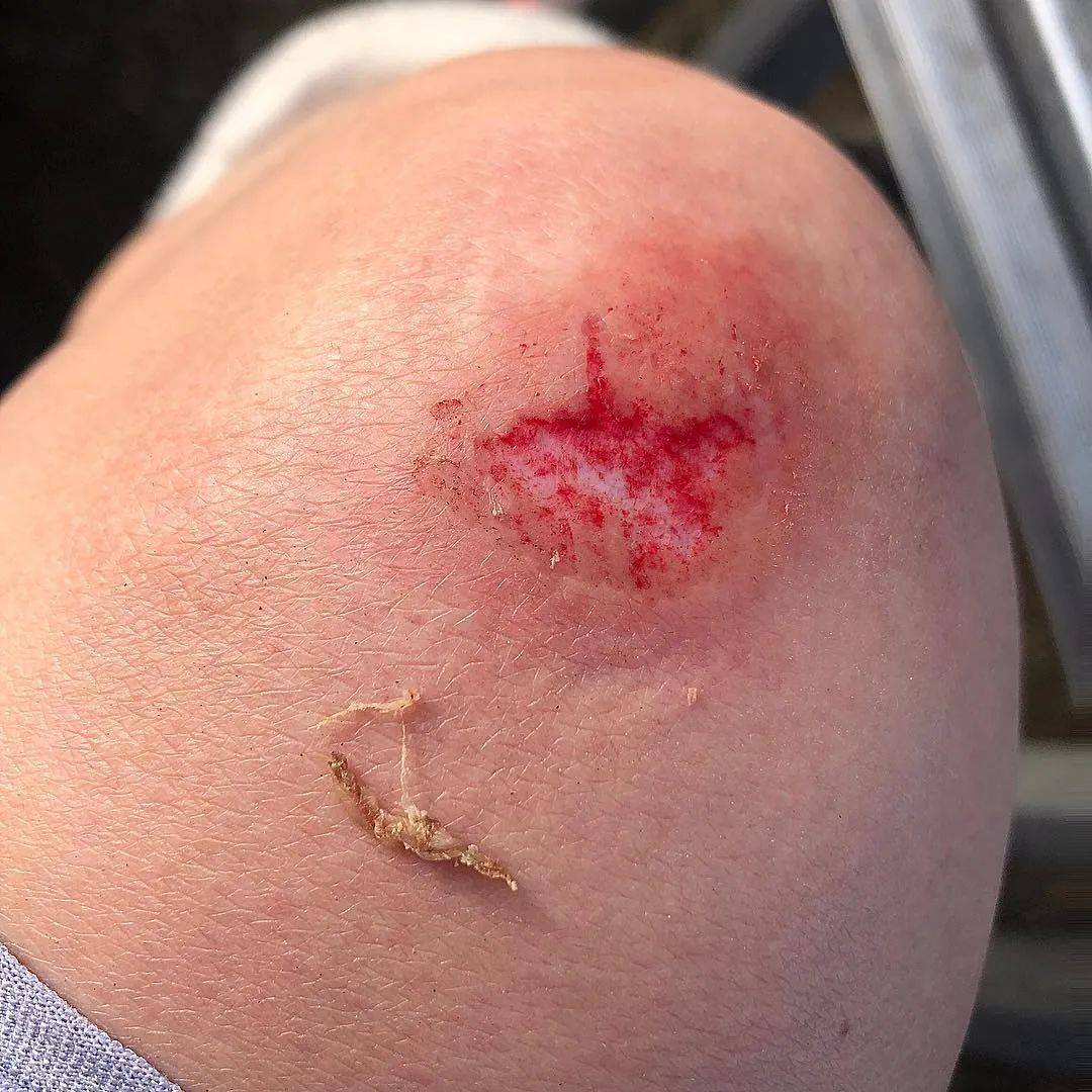 摔伤破皮，如何护理不留疤痕？