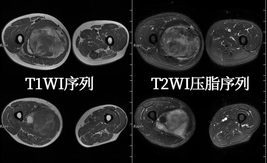 腹膜後病例來一波脂肪肉瘤夠典型不