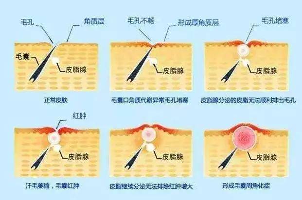 诱发痤疮形成的根本原因之间,其实是一系列的连环反应.