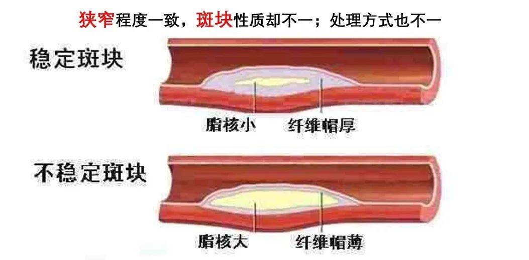 狭窄与斑块的区别2,建议:在"无症状颈动脉狭窄是否需要筛查"这个议题
